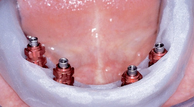 Zahnersatz im Alter – Implantologie hilft