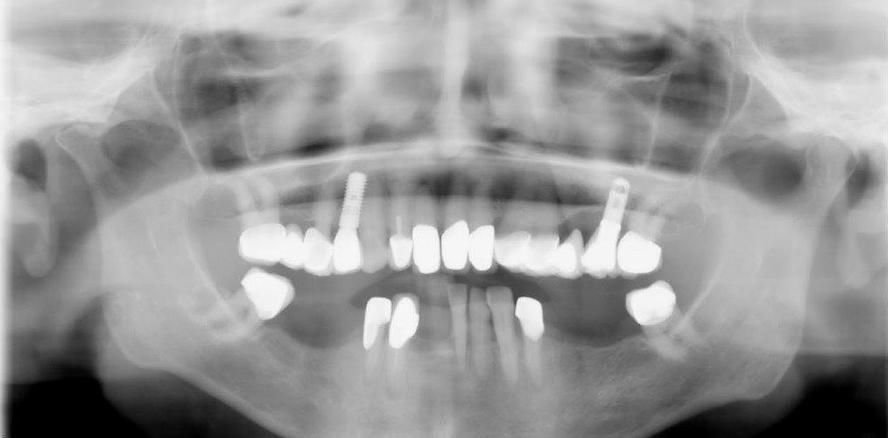 Sofortversorgung mit Implantaten im prämolaren Bereich des Oberkiefers