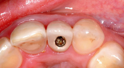 Implantation nach der Extraktion von Einzelzähnen