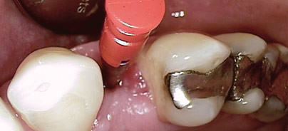 Der Einsatz von Implantaten bei ­schwierigen Indikationen