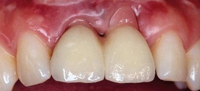 Bewertung von Implantatversorgungen