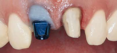 Rundum-Implantatversorgung an einem Tag