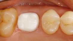 Implantation im Seitenzahn­bereich – ästhetisch und minimalinvasiv