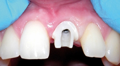 Der Spätverlust als Traumafolge – Implantation als „best chance“