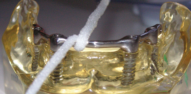 Langzeiterfolg von Implantatversorgungen – Therapiekonzepte