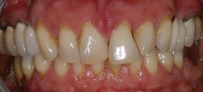 Zahnerhalt vs. Implantation