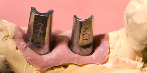 Abrechnung präparierter Implantatpfosten