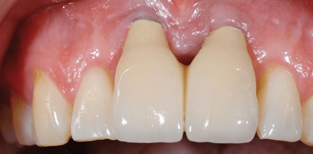 Ästhetische Misserfolge in der Implantologie: Ursachen und Therapie