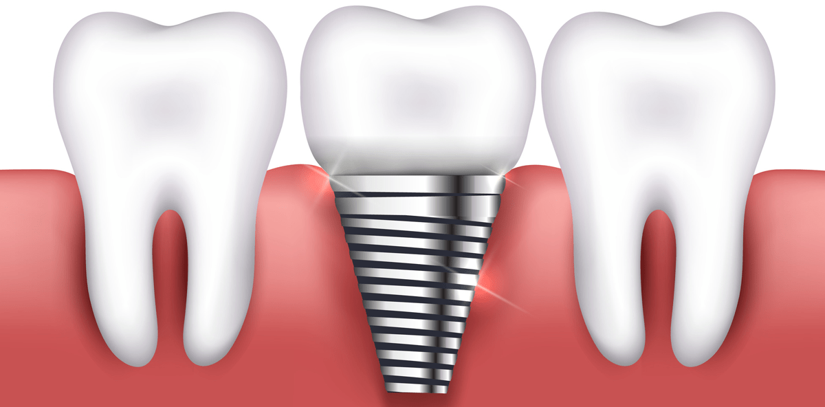 Silber & Co. sollen Implantate sicherer machen