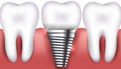 Silber & Co. sollen Implantate sicherer machen