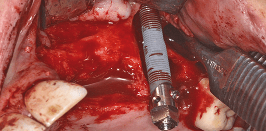 Zygoma-Implantat im Oberkiefer