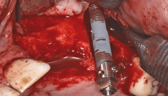 Zygoma-Implantat im Oberkiefer