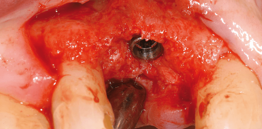 Minimalinvasives Alveolen­management zur Implantatinsertion bereits nach drei Monaten