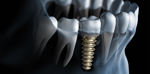 Implantat: Mit Mathematik passt's besser