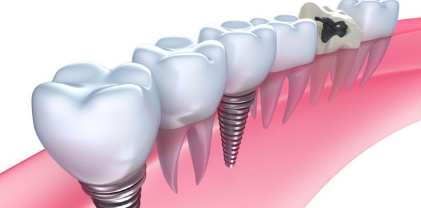 Straumann: Studie belegt Verlässlichkeit von Implantaten