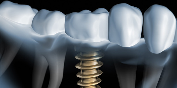 Laserpolitur beschleunigt Oberflächenfinish von Implantaten