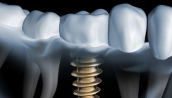 Laserpolitur beschleunigt Oberflächenfinish von Implantaten