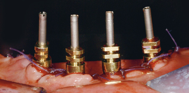 Transgingivale Implantate im zahnlosen Unterkiefer