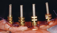 Transgingivale Implantate im zahnlosen Unterkiefer
