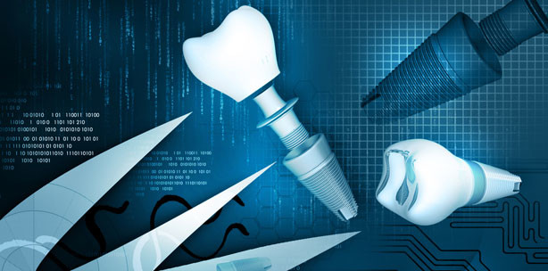 Implantate sparen Kosten und verbessern die Lebensqualität