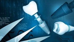 Implantate sparen Kosten und verbessern die Lebensqualität