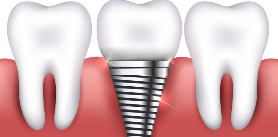 Implantat mit eingebautem Speicher soll Infektionsrisiko senken