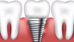 Implantat mit eingebautem Speicher soll Infektionsrisiko senken