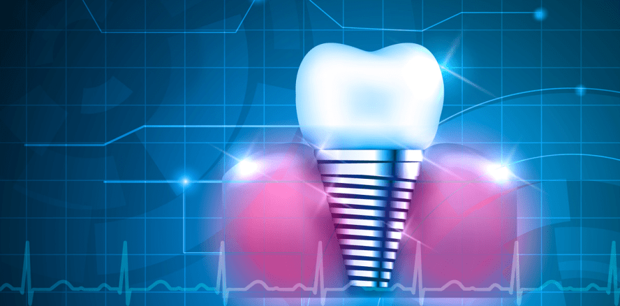Infektionen an Zahnimplantaten vermeiden