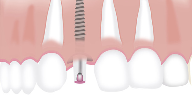 Implantate: Neue Beschichtung verbessert Behandlungserfolg