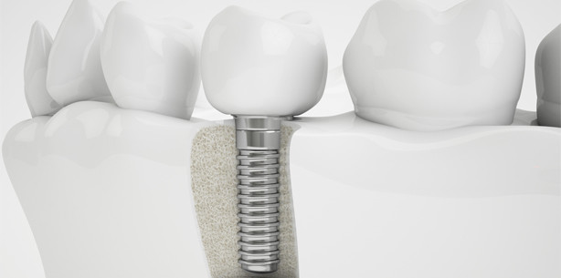 Geschädigter Nerv bei Implantation kostet Behandler 5.000 Euro