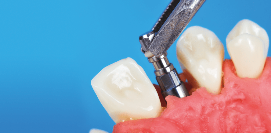 Implantataustausch auf Kosten der Hersteller?!