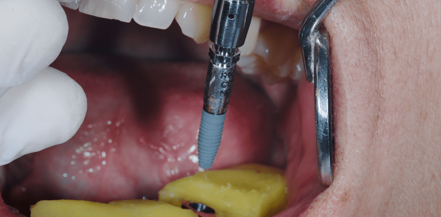 Computergestützte Implantatchirurgie mit Sofortbelastung