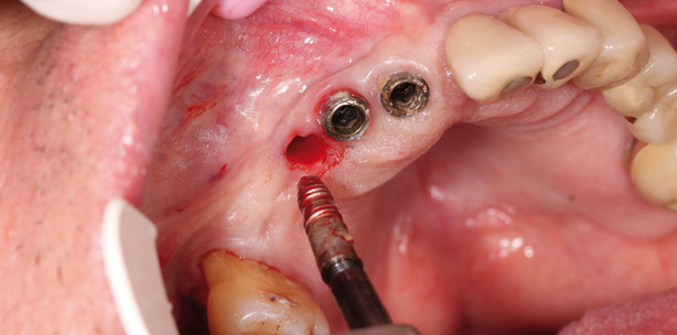 Implantatentfernung: Suche nach der schonendsten Methode