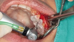 GOZ 2012 – Implantatinsertion – aus drei mach eins