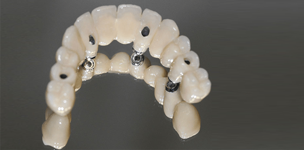 Minimalinvasives, prothetisches Implantatkonzept mit einteilig verschraubter Lösung