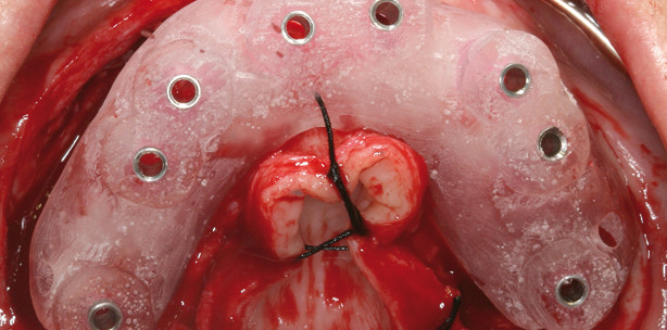 Virtuelle Implantatplanung im Vergleich