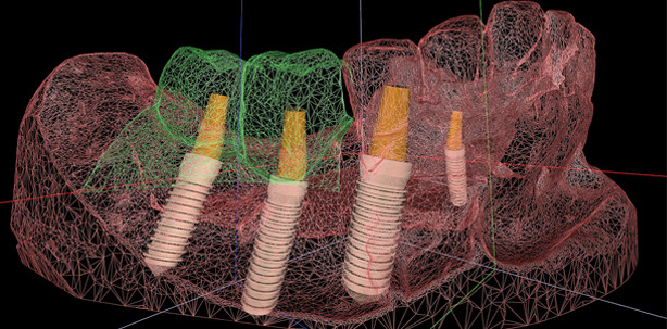 Optimierte Implantatplanung: DICOM-STL-Matching