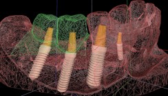 Optimierte Implantatplanung: DICOM-STL-Matching