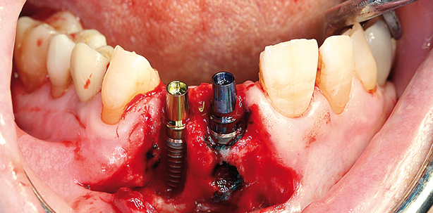 Implantatsofortinsertion bei reduziertem Knochenangebot