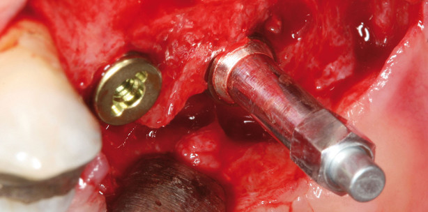 Risikomanagement – objektive ­Beurteilung der Implantatstabilität