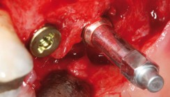 Risikomanagement – objektive Beurteilung der Implantatstabilität