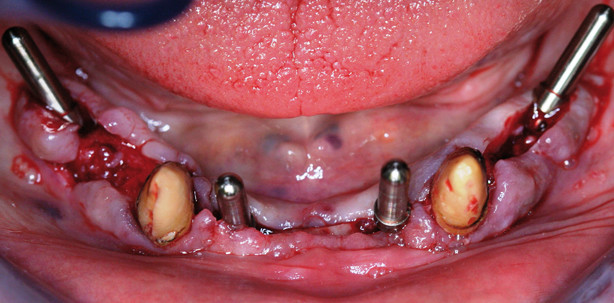 Präklinische und klinische Aspekte moderner Implantatsysteme