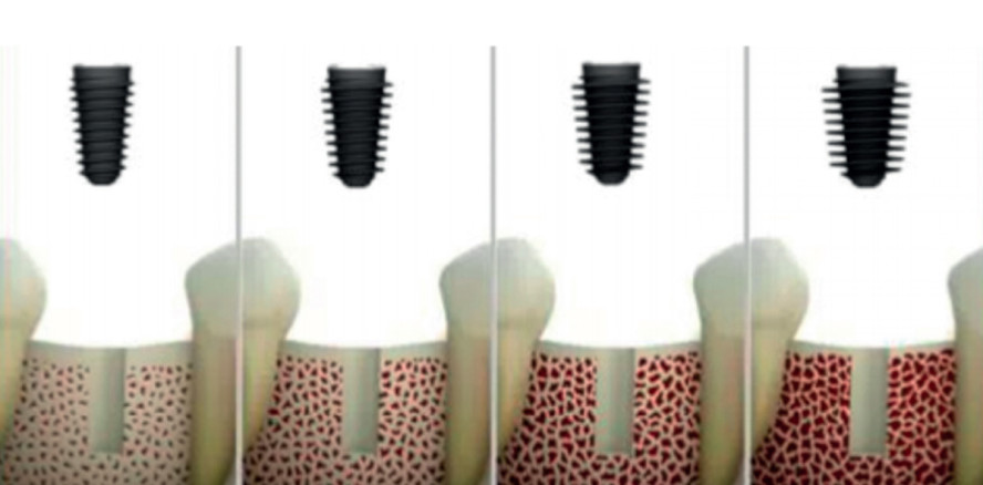 Ein Implantatsystem auf dem Prüfstein