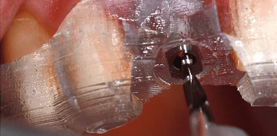 Differenzialanwendung von Implantatplattformen