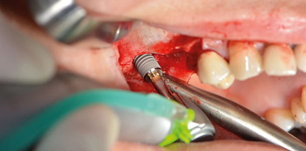 Implantattherapie: Einfach, sicher und reproduzierbar