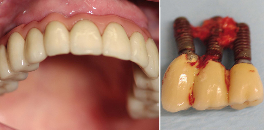 Die „T’s“ in der Implantologie – von Triumphen und Tragödien