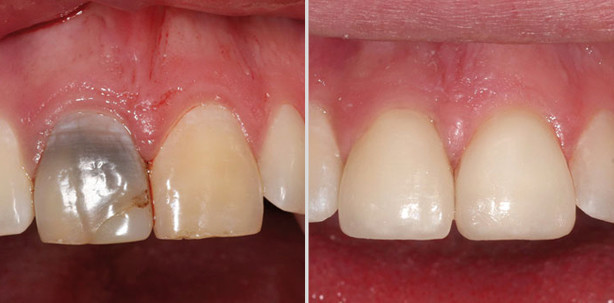 Ästhetik in der Implantologie: Welche Therapie passt zu welchem Fall?