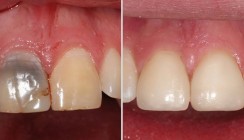 Ästhetik in der Implantologie: Welche Therapie passt zu welchem Fall?