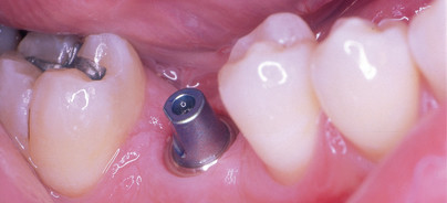 Ein persönlicher Rückblick auf Entwicklungen der oralen Implantologie