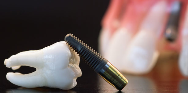 Zur Lage der Implantologie in der Schweiz